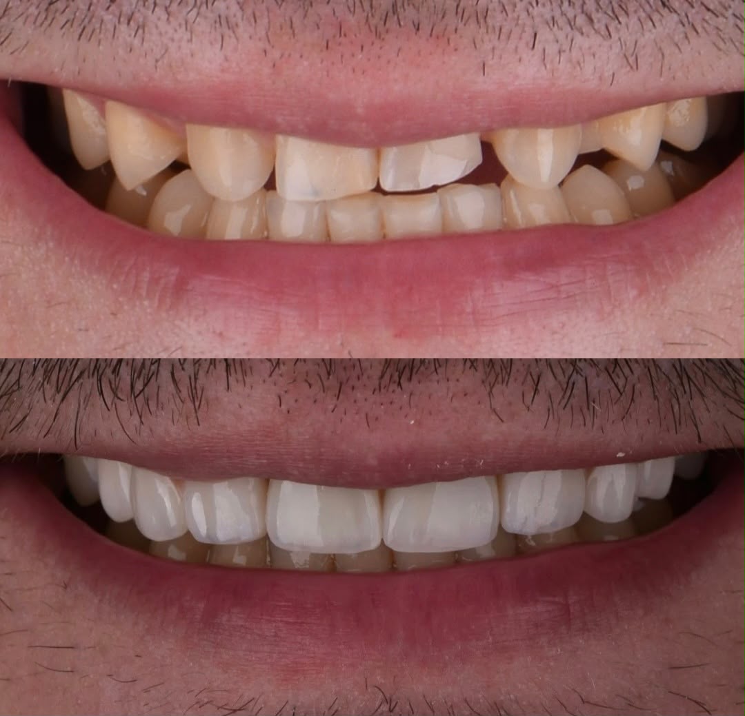 Before & After result