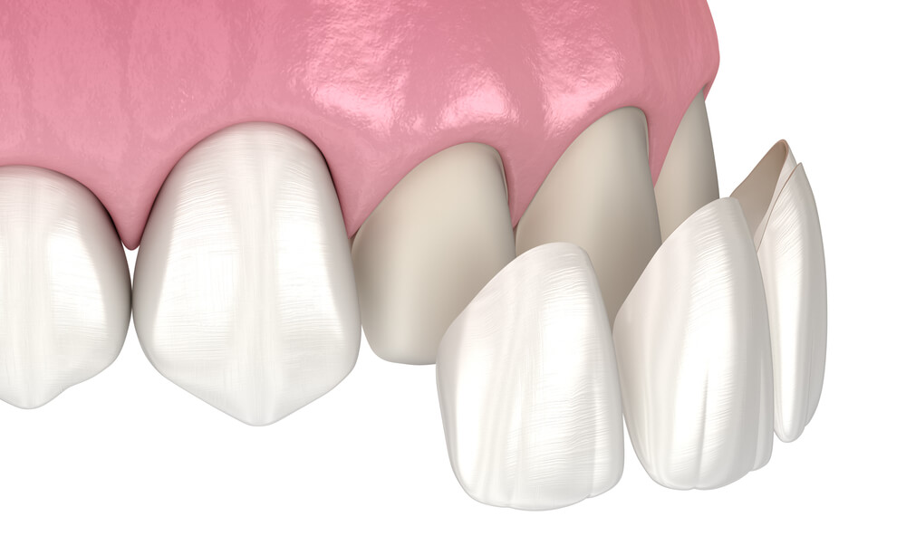 Veneers